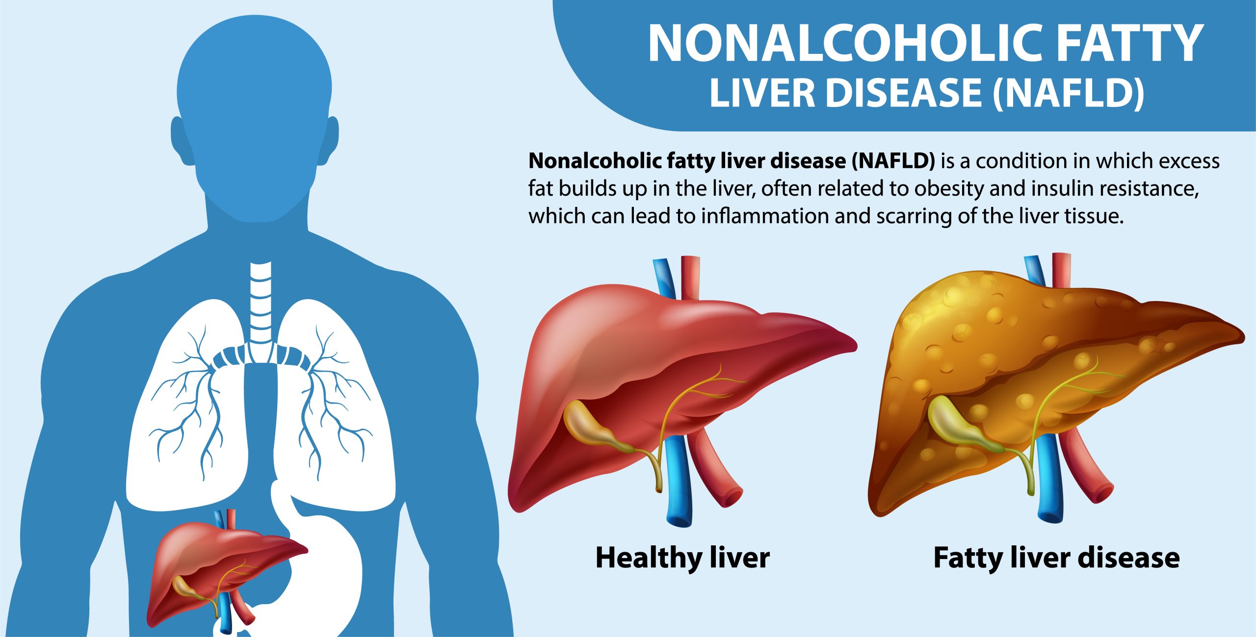 Nonalcoholic Fatty Liver Disease NAFLD - ECA Healthcare | Official Site Nonalcoholic Fatty Liver Disease NAFLD